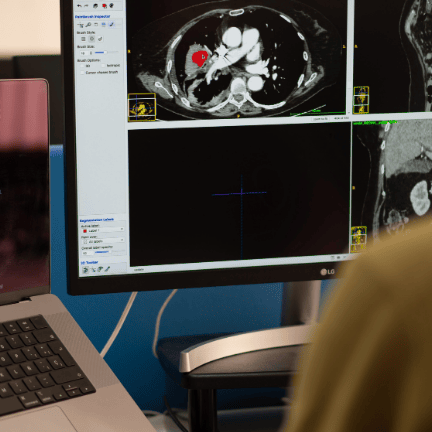 Quibim QP Prostate platform on a laptop and computer screen, showing AI-powered imaging biomarkers.